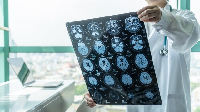 Jedna krvna grupa ima veći rizik od moždanog udara, tvrde naučnici